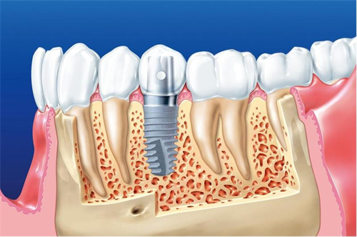 Quy trình cấy ghép Implant